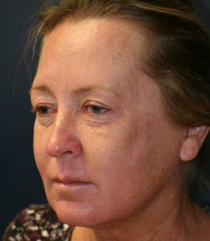 Lip Lift San Diego 19 - before - oblique