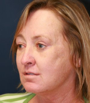 Lip Lift San Diego 19 - after - oblique