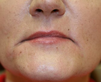 Filler in frown lines San Diego - before - front