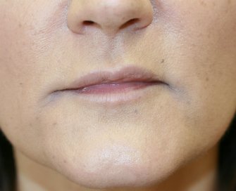 Filler in frown lines San Diego - after - front