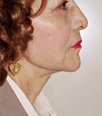 Necklift Case 6 - after - front