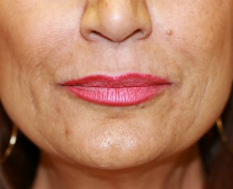 Hyaluronan gel (Juvederm) around lips - before - front