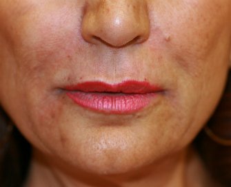 Hyaluronan gel (Juvederm) around lips - after - front