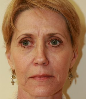 Liquid Facelift with Radiesse - before - front