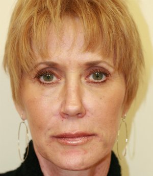 Liquid Facelift with Radiesse - after - front