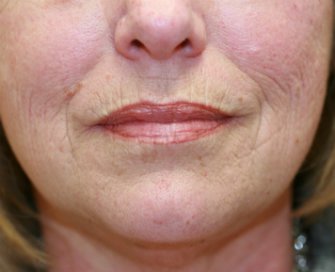 Restylane in creases at sides of lips - before - front