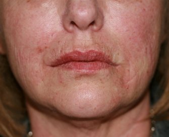 Restylane in creases at sides of lips - after - front