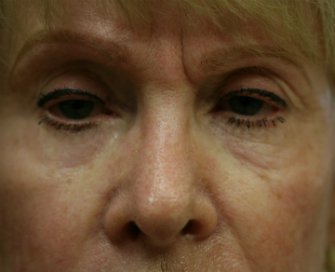 Expression gel San Diego in Lower Eyelids - before - front
