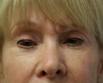 Expression gel San Diego in Lower Eyelids - after - front