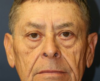 Sculptra lower eyelids - before - front