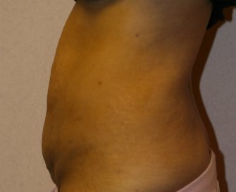 Tummy Tuck Case 16 - before - side