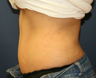 Tummy Tuck Case 16 - after - side