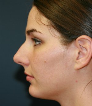 Rhinoplasty San Diego 41 - before - front