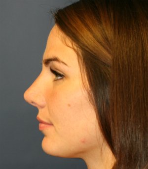 Rhinoplasty San Diego 41 - after - front