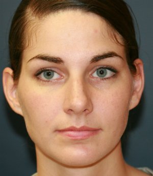 Rhinoplasty San Diego 41 - before - oblique