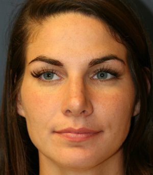 Rhinoplasty San Diego 41 - after - oblique