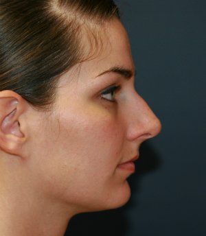 Rhinoplasty San Diego 41 - before - side