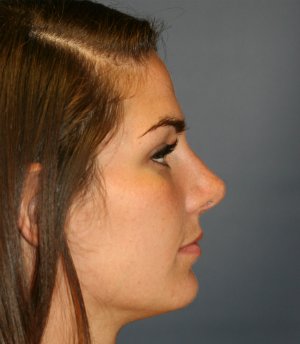 Rhinoplasty San Diego 41 - after - side