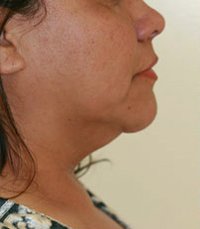 Necklift Case 7 - before - front