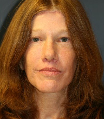 Forehead Lift San Diego 14 - after - front