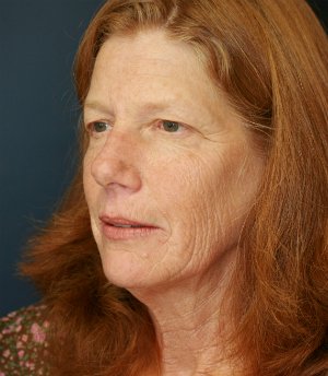 Forehead Lift San Diego 14 - before - oblique