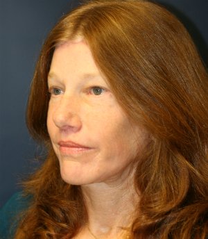 Forehead Lift San Diego 14 - after - oblique
