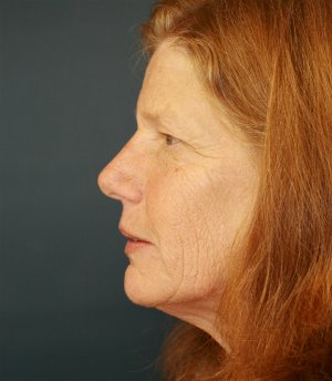 Forehead Lift San Diego 14 - before - side