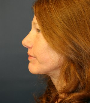 Forehead Lift San Diego 14 - after - side