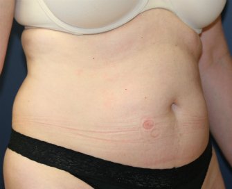 Tummy Tuck San Diego 46 - before - front
