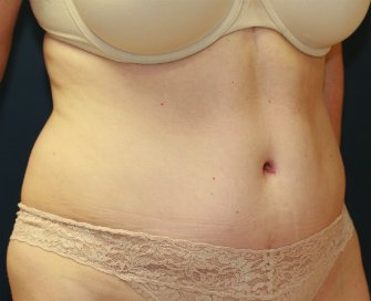 Tummy Tuck San Diego 46 - after - front