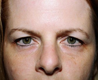 Blepharoplasty Case 3 - before - front