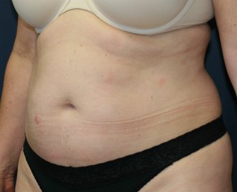 Tummy Tuck San Diego 46 - before - oblique