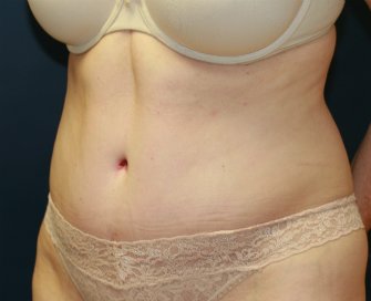 Tummy Tuck San Diego 46 - after - oblique