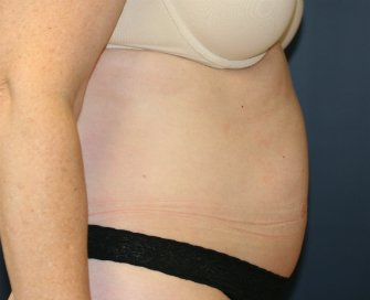 Tummy Tuck San Diego 46 - before - side