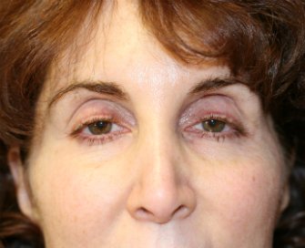 Eyelid Surgery San Diego 53 - before - front