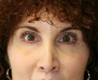 Eyelid Surgery San Diego 53 - after - front