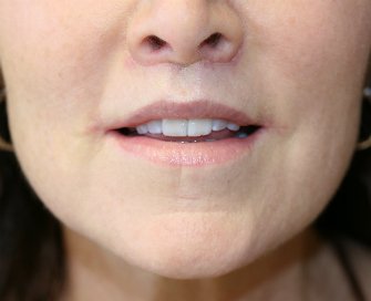 Lip lift and corner lift 22 - after - front