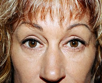 Blepharoplasty Case 4 - after - front
