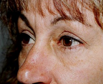 Blepharoplasty Case 4 - before - angle