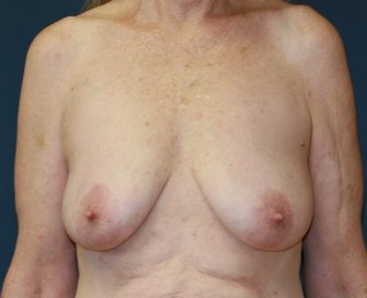 Breast Lift San Diego 21 - before - front