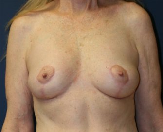 Breast Lift San Diego 21 - after - front