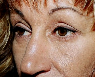 Blepharoplasty Case 4 - after - angle