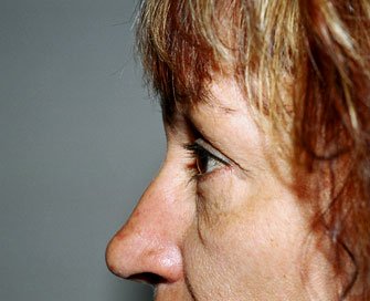 Blepharoplasty Case 4 - before - side
