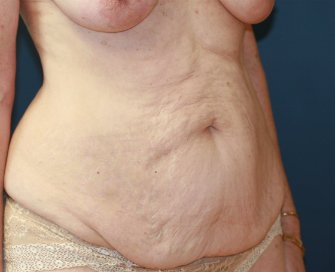 Tummy Tuck San Diego 48 - before - oblique