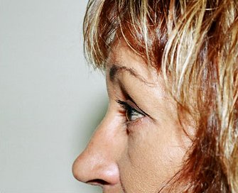 Blepharoplasty Case 4 - after - side