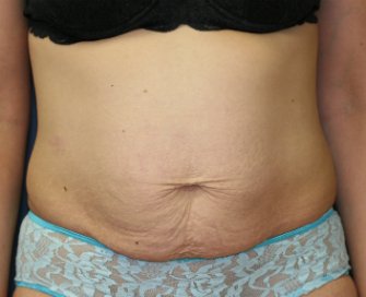 Tummy Tuck San Diego 49 - before - front
