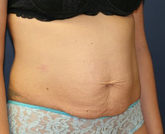 Tummy Tuck San Diego 49 - before - oblique