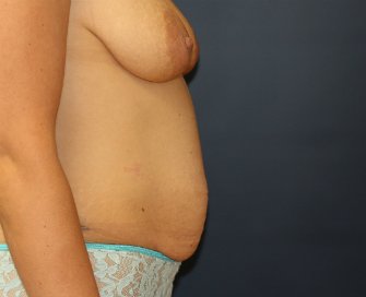 Tummy Tuck San Diego 49 - before - side