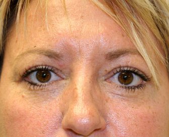 Blepharoplasty Case 5 - after - front