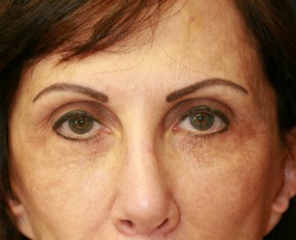 eye-lift-san-diego-58 - before - front